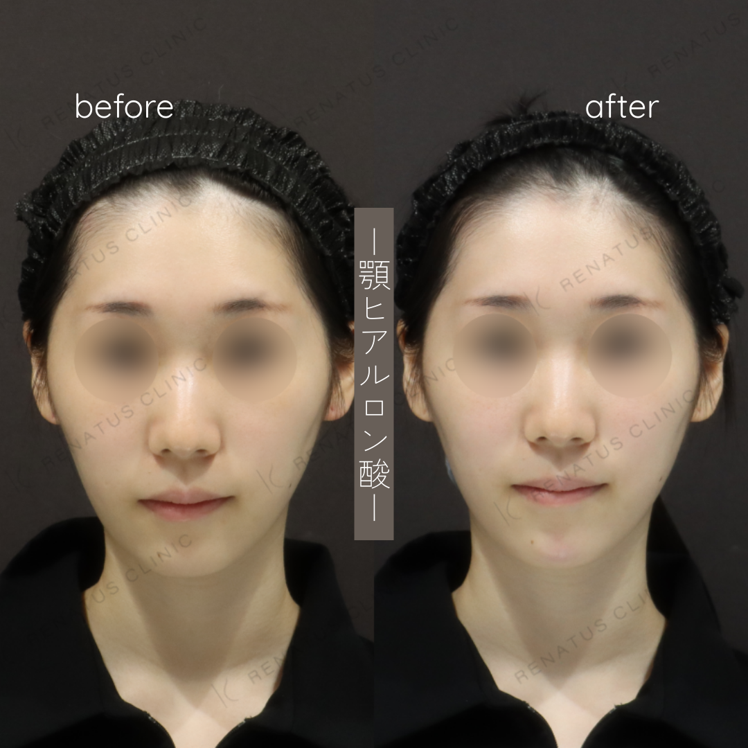 顎ヒアルロン酸ボラックス症例写真 顎ヒアルロン酸ボラックス症例写真