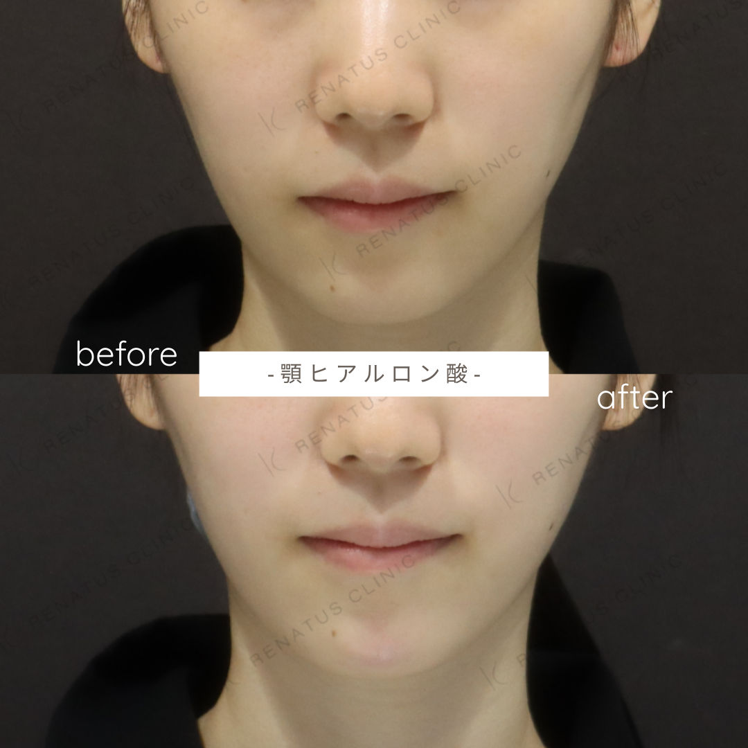 顎ヒアルロン酸ボラックス症例写真 顎ヒアルロン酸ボラックス症例写真