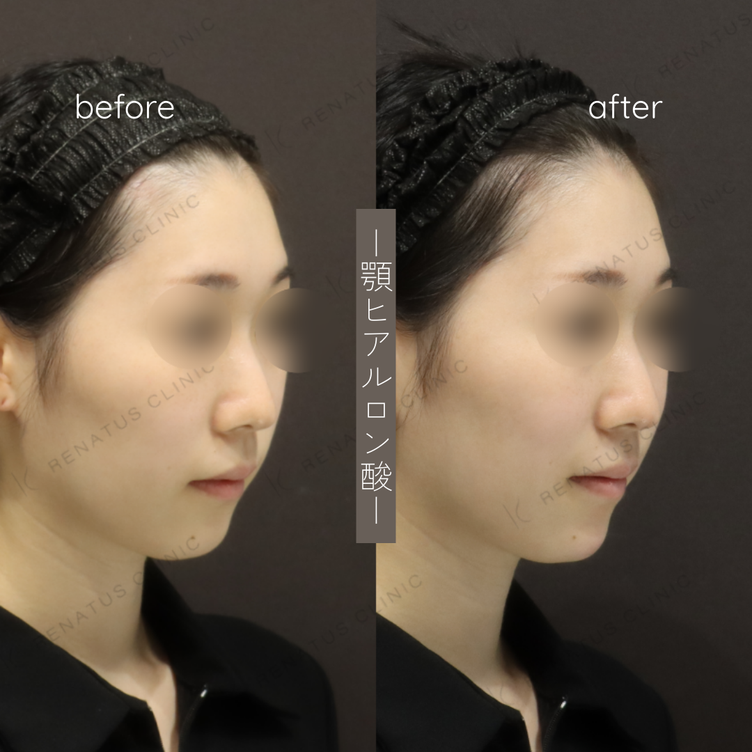 顎ヒアルロン酸ボラックス症例写真 顎ヒアルロン酸ボラックス症例写真
