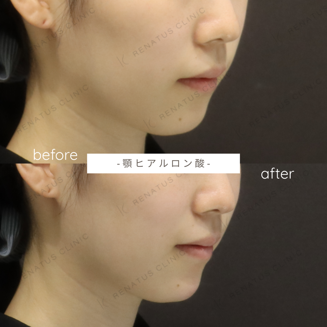 顎ヒアルロン酸ボラックス症例写真 顎ヒアルロン酸ボラックス症例写真