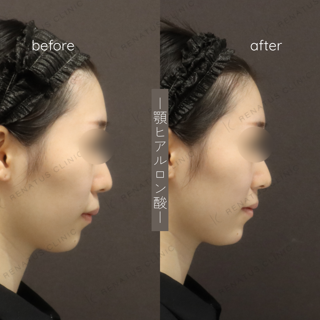 顎ヒアルロン酸ボラックス症例写真 顎ヒアルロン酸ボラックス症例写真