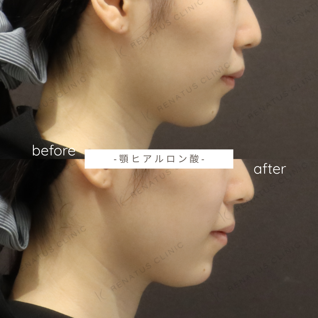 顎ヒアルロン酸ボラックス症例写真 顎ヒアルロン酸ボラックス症例写真