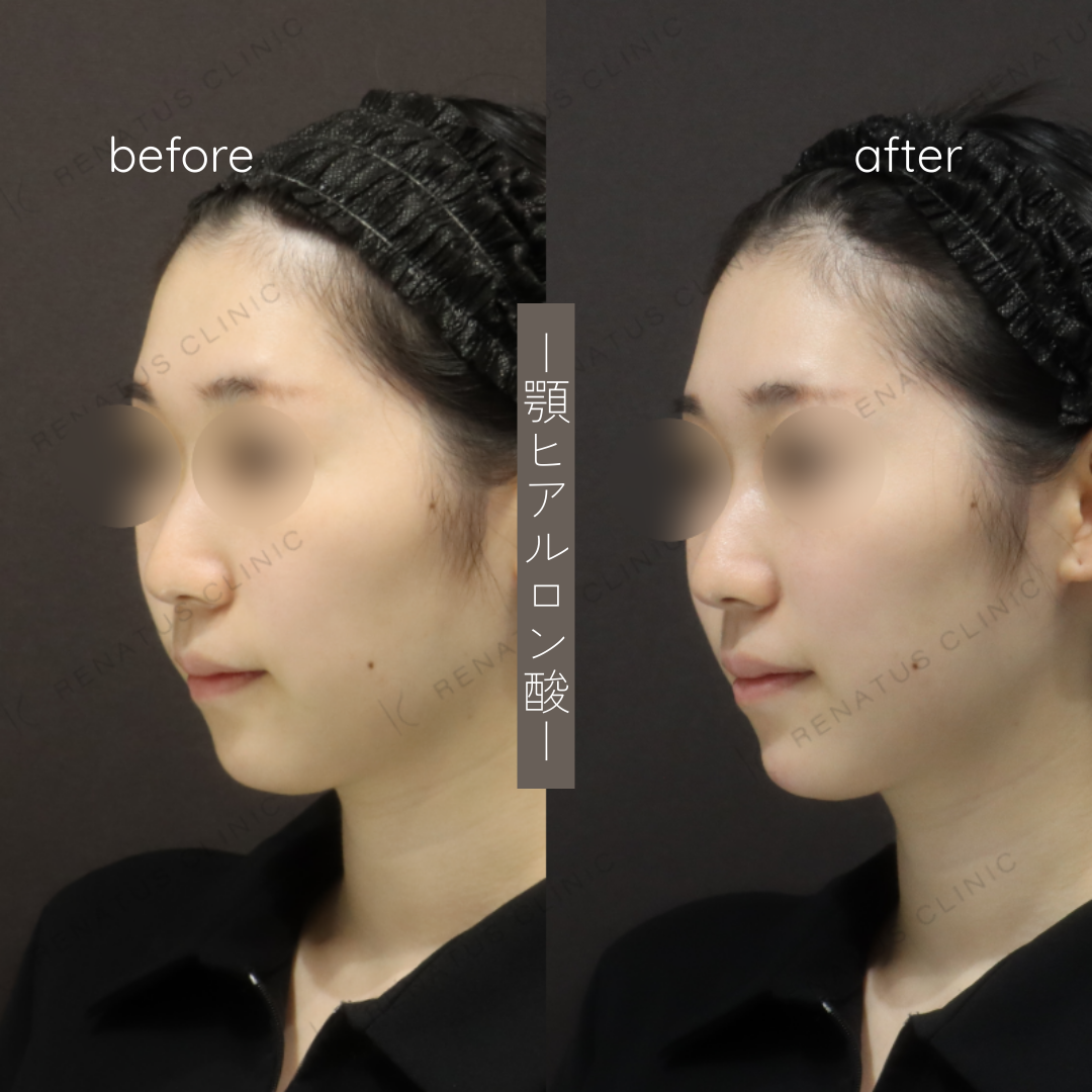 顎ヒアルロン酸ボラックス症例写真 顎ヒアルロン酸ボラックス症例写真