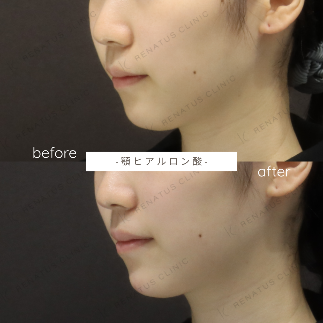 顎ヒアルロン酸ボラックス症例写真 顎ヒアルロン酸ボラックス症例写真