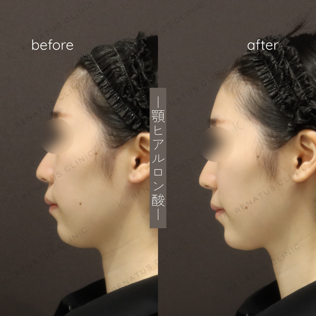 顎ヒアルロン酸ボラックス症例写真 顎ヒアルロン酸ボラックス症例写真