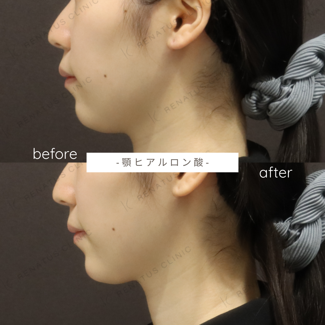 顎ヒアルロン酸ボラックス症例写真 顎ヒアルロン酸ボラックス症例写真