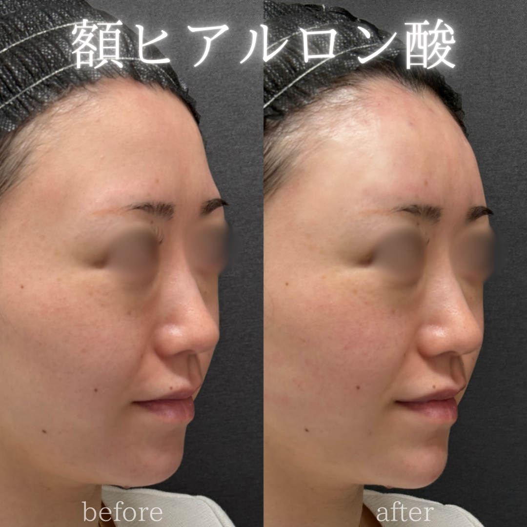 額ヒアルロン酸ボリューマ症例写真 額ヒアルロン酸ボリューマ症例写真