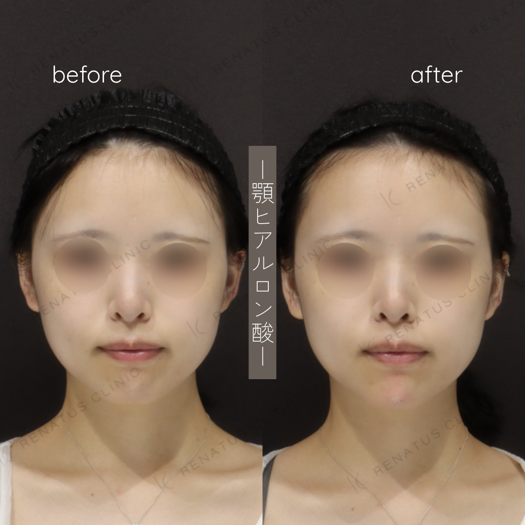 お試しヒアルロン酸(顎)症例写真 お試しヒアルロン酸(顎)症例写真