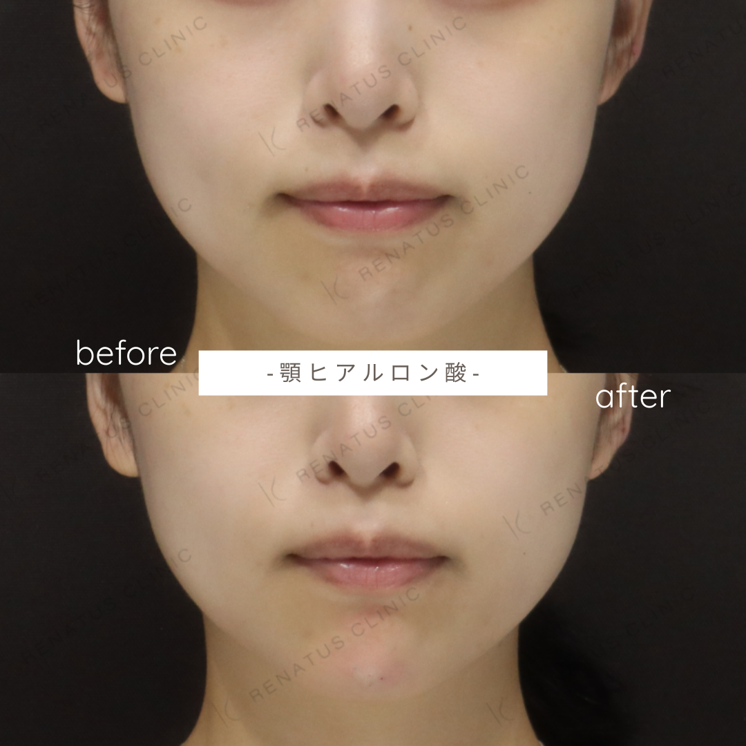 お試しヒアルロン酸(顎)症例写真 お試しヒアルロン酸(顎)症例写真
