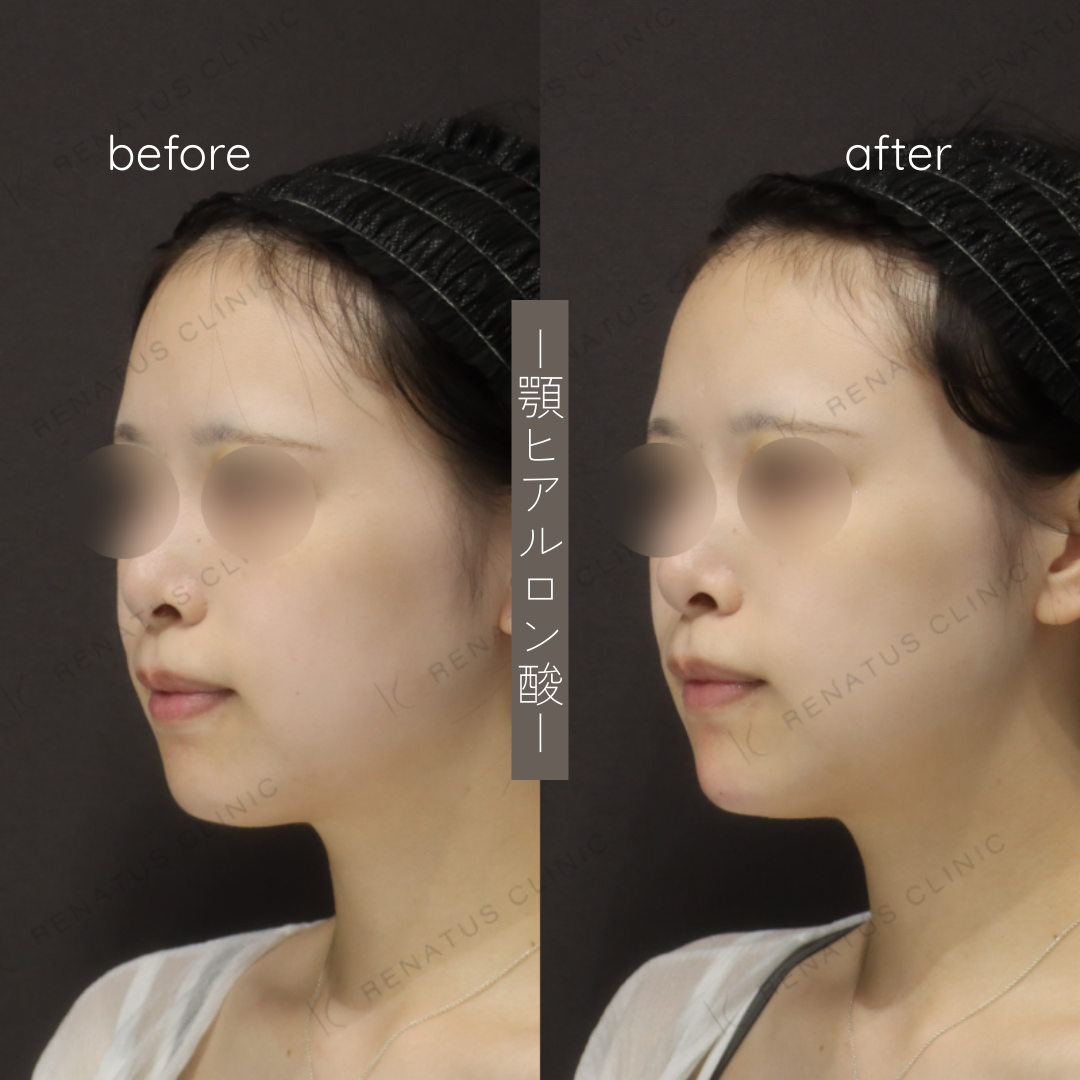 お試しヒアルロン酸(顎)症例写真 お試しヒアルロン酸(顎)症例写真