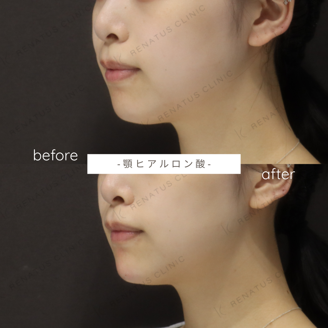 お試しヒアルロン酸(顎)症例写真 お試しヒアルロン酸(顎)症例写真