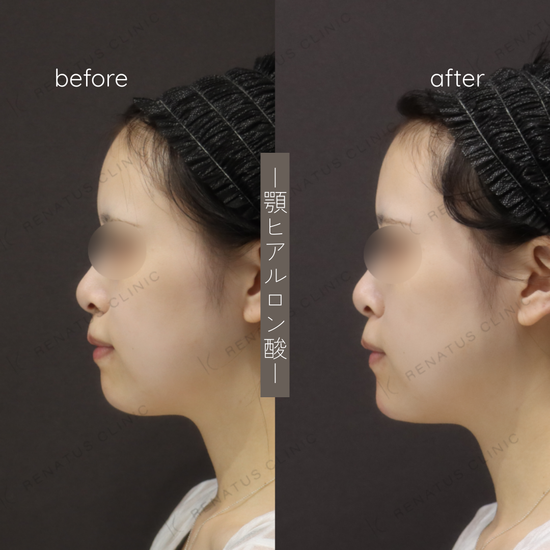 お試しヒアルロン酸(顎)症例写真 お試しヒアルロン酸(顎)症例写真