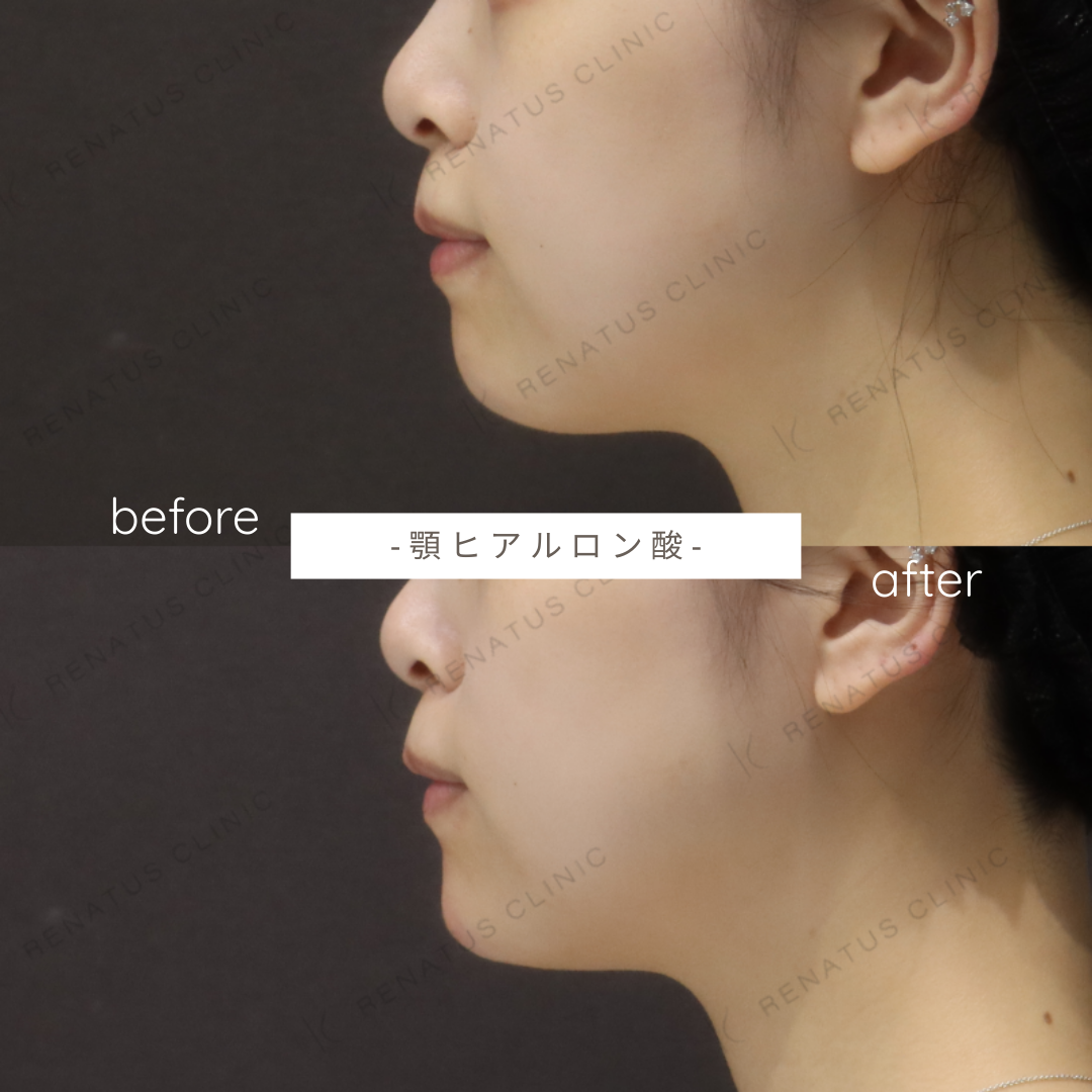 お試しヒアルロン酸(顎)症例写真 お試しヒアルロン酸(顎)症例写真