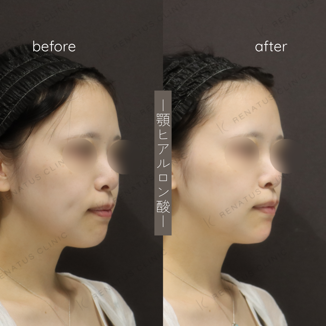 お試しヒアルロン酸(顎)症例写真 お試しヒアルロン酸(顎)症例写真