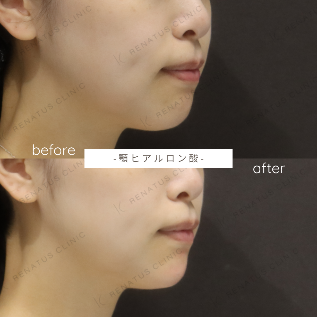 お試しヒアルロン酸(顎)症例写真 お試しヒアルロン酸(顎)症例写真