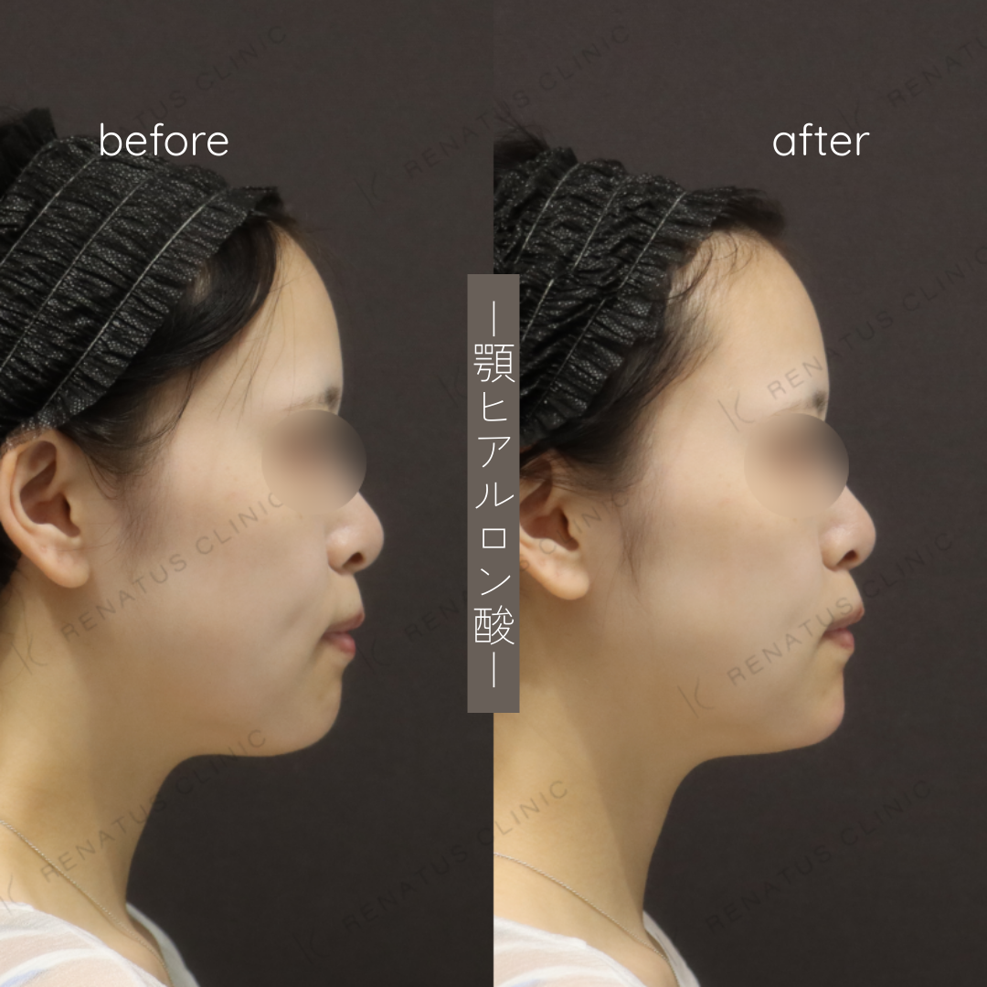 お試しヒアルロン酸(顎)症例写真 お試しヒアルロン酸(顎)症例写真