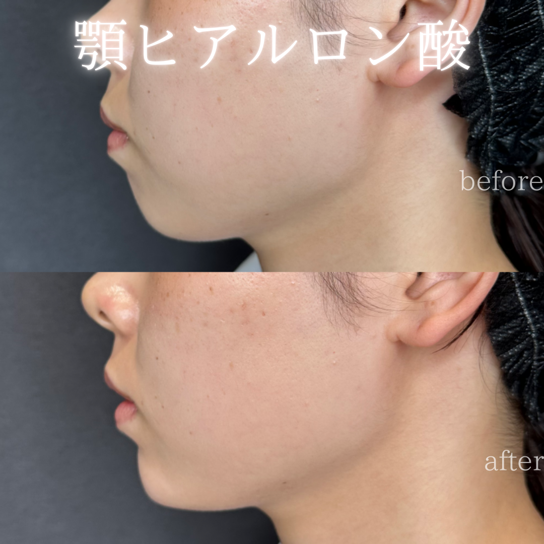 顎ヒアルロン酸ボラックス症例写真 顎ヒアルロン酸ボラックス症例写真