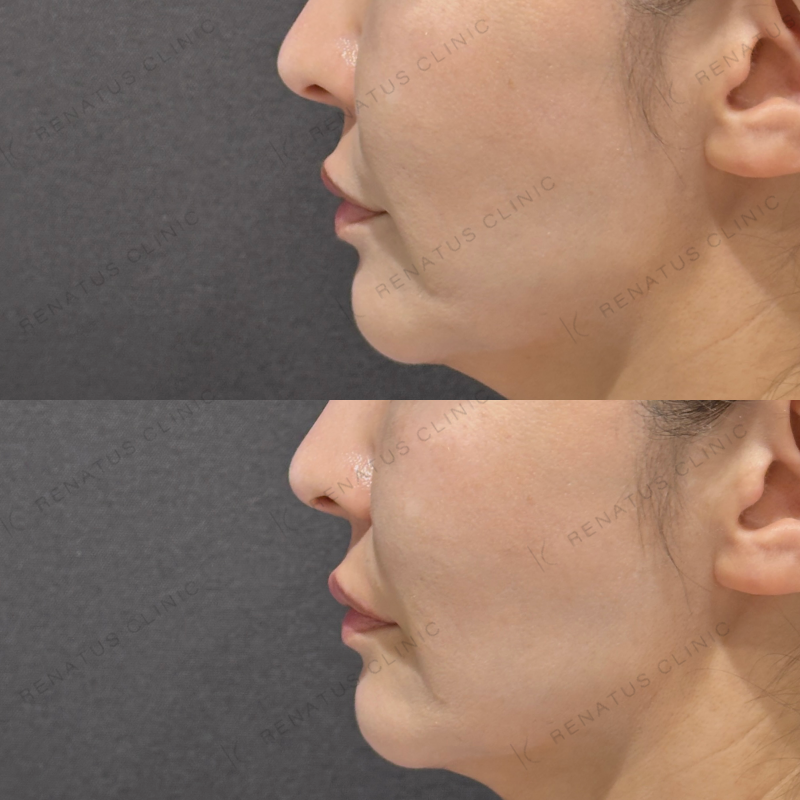 唇ヒアルロン酸ボルベラ症例写真 唇ヒアルロン酸ボルベラ症例写真