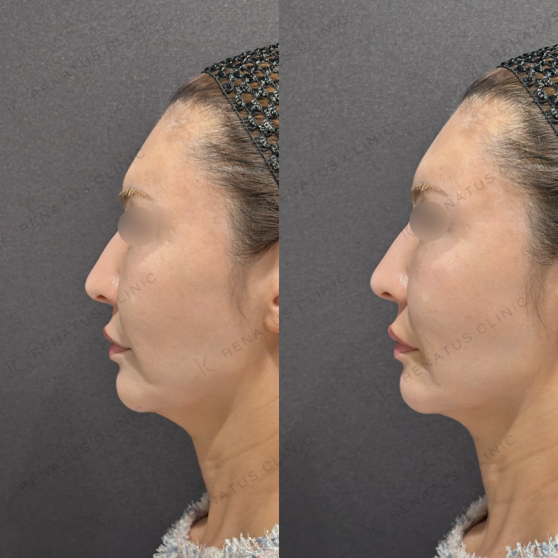 唇ヒアルロン酸ボルベラ症例写真 唇ヒアルロン酸ボルベラ症例写真