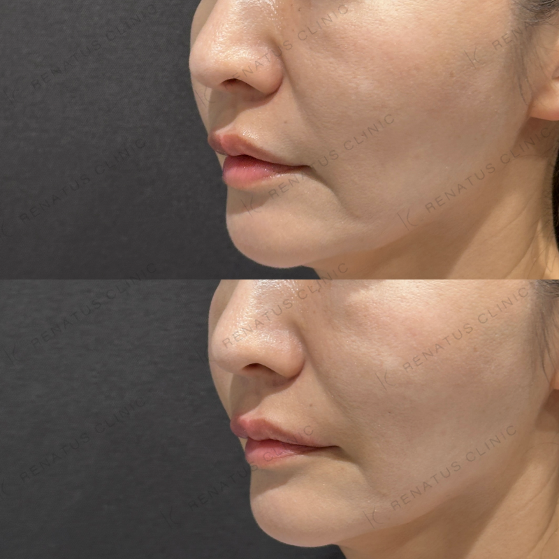 唇ヒアルロン酸ボルベラ症例写真 唇ヒアルロン酸ボルベラ症例写真