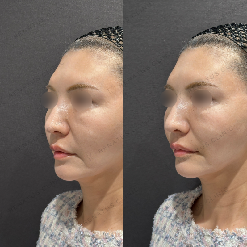 唇ヒアルロン酸ボルベラ症例写真 唇ヒアルロン酸ボルベラ症例写真