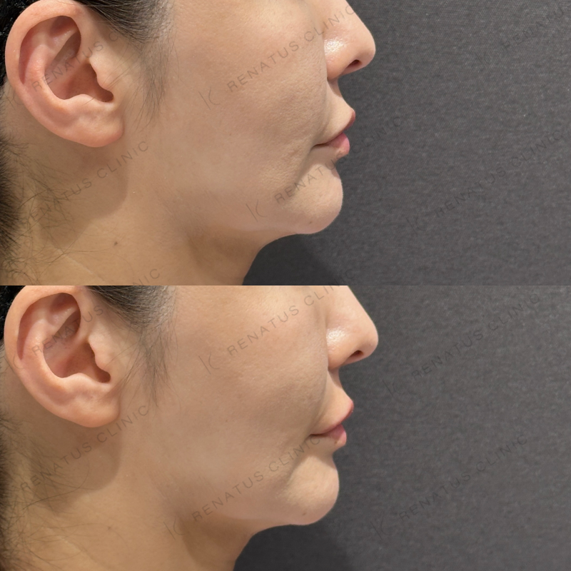 唇ヒアルロン酸ボルベラ症例写真 唇ヒアルロン酸ボルベラ症例写真