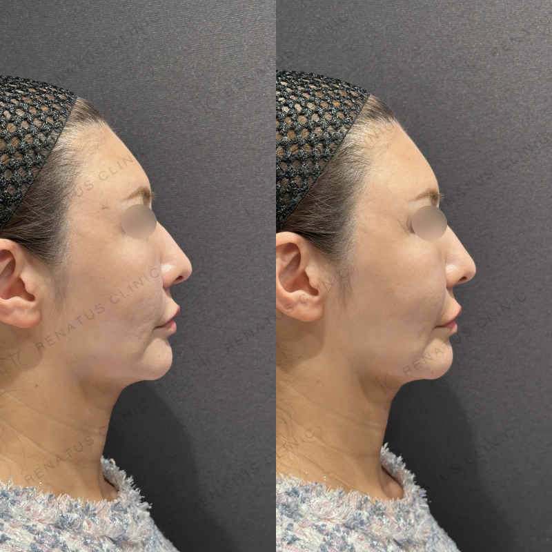 唇ヒアルロン酸ボルベラ症例写真 唇ヒアルロン酸ボルベラ症例写真