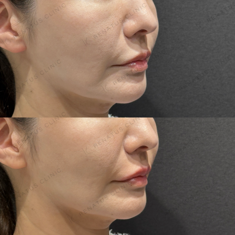 唇ヒアルロン酸ボルベラ症例写真 唇ヒアルロン酸ボルベラ症例写真