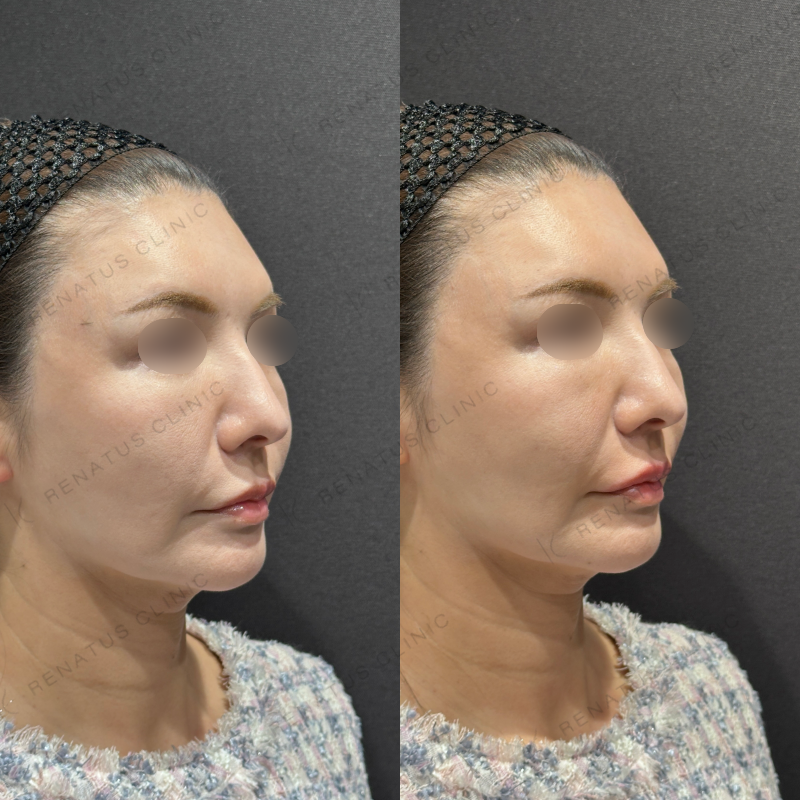 唇ヒアルロン酸ボルベラ症例写真 唇ヒアルロン酸ボルベラ症例写真