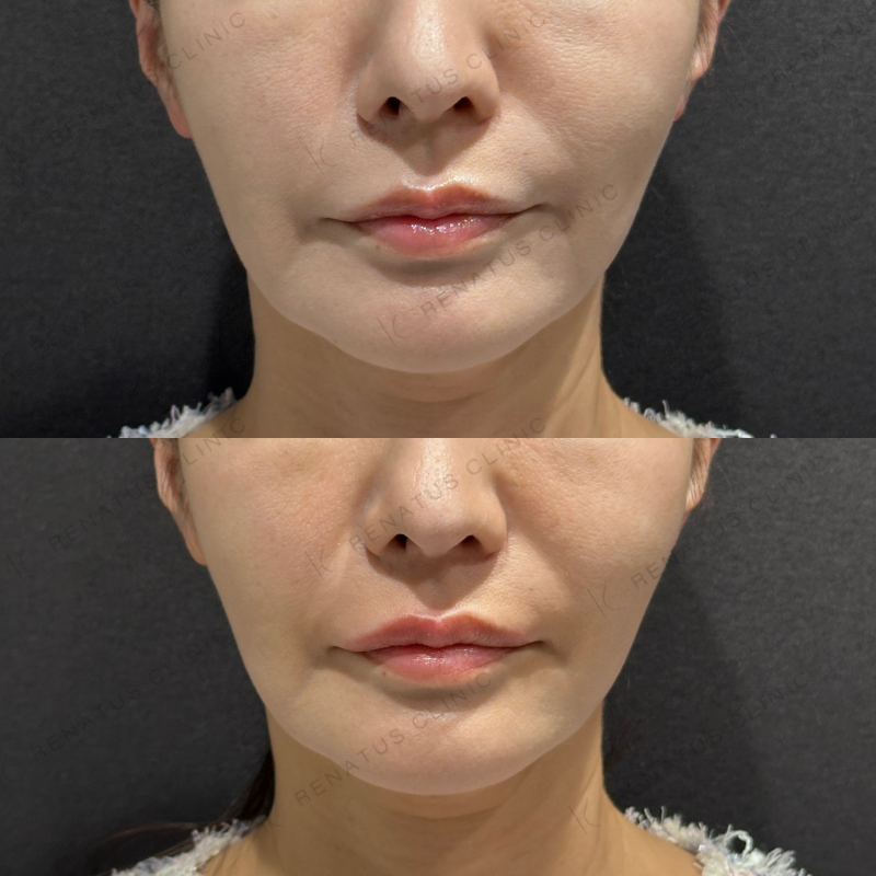 唇ヒアルロン酸ボルベラ症例写真 唇ヒアルロン酸ボルベラ症例写真