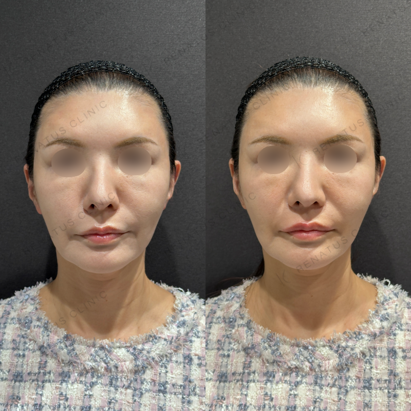 唇ヒアルロン酸ボルベラ症例写真 唇ヒアルロン酸ボルベラ症例写真