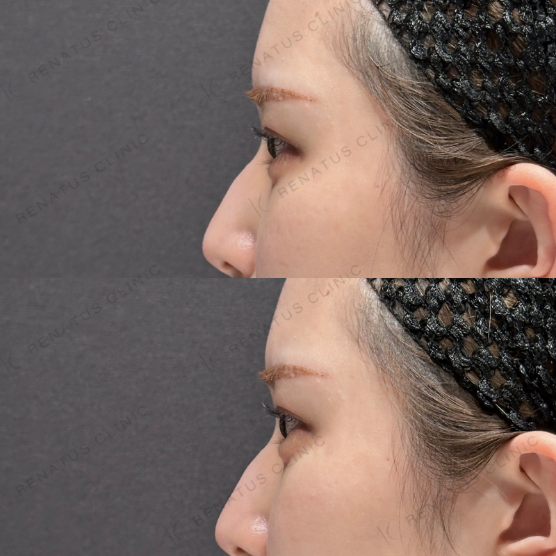 涙袋ヒアルロン酸ボルベラ症例写真505 涙袋ヒアルロン酸ボルベラ症例写真