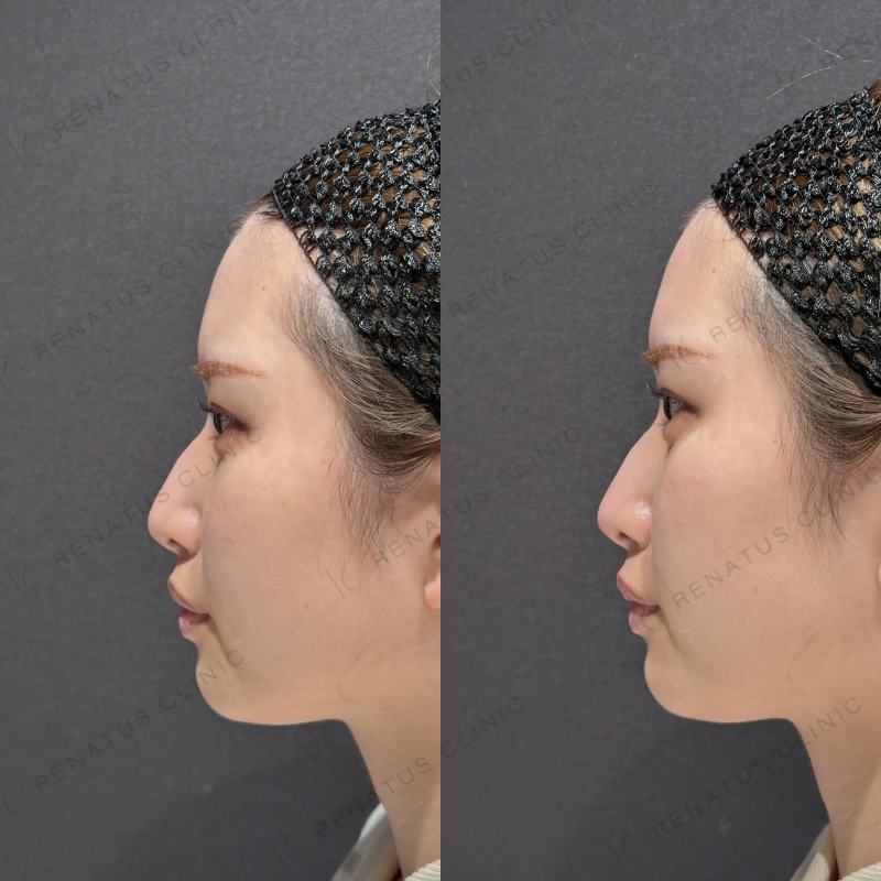 涙袋ヒアルロン酸ボルベラ症例写真 涙袋ヒアルロン酸ボルベラ症例写真