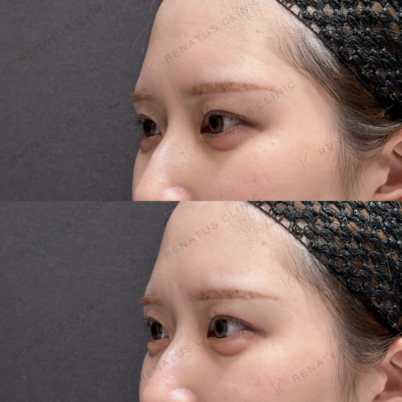 涙袋ヒアルロン酸ボルベラ症例写真 涙袋ヒアルロン酸ボルベラ症例写真