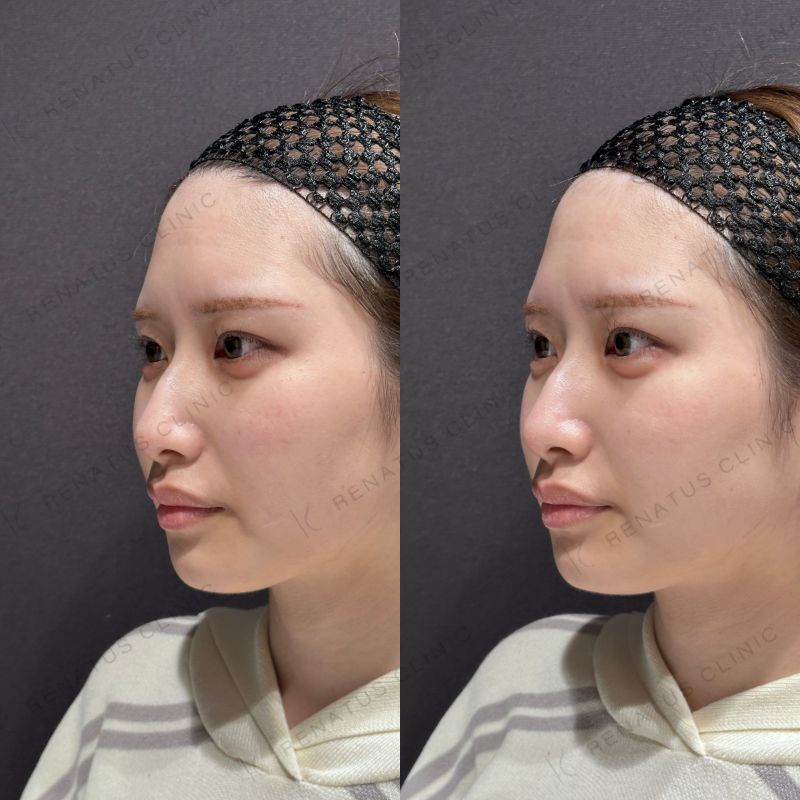 涙袋ヒアルロン酸ボルベラ症例写真 涙袋ヒアルロン酸ボルベラ症例写真