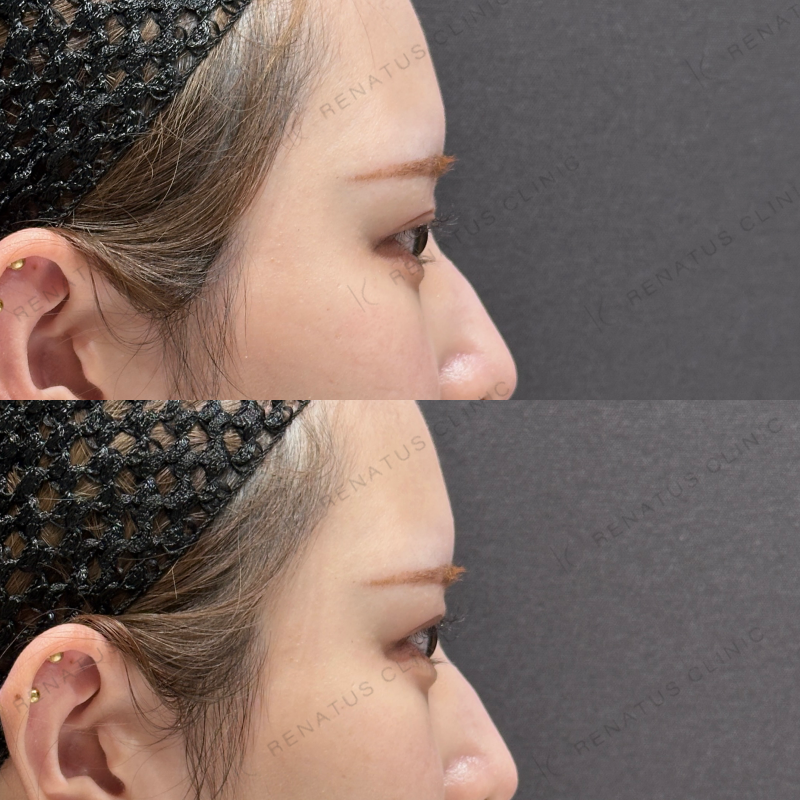 涙袋ヒアルロン酸ボルベラ症例写真 涙袋ヒアルロン酸ボルベラ症例写真