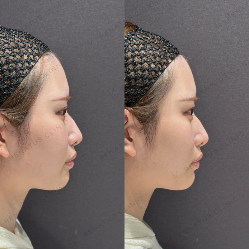 涙袋ヒアルロン酸ボルベラ症例写真 涙袋ヒアルロン酸ボルベラ症例写真