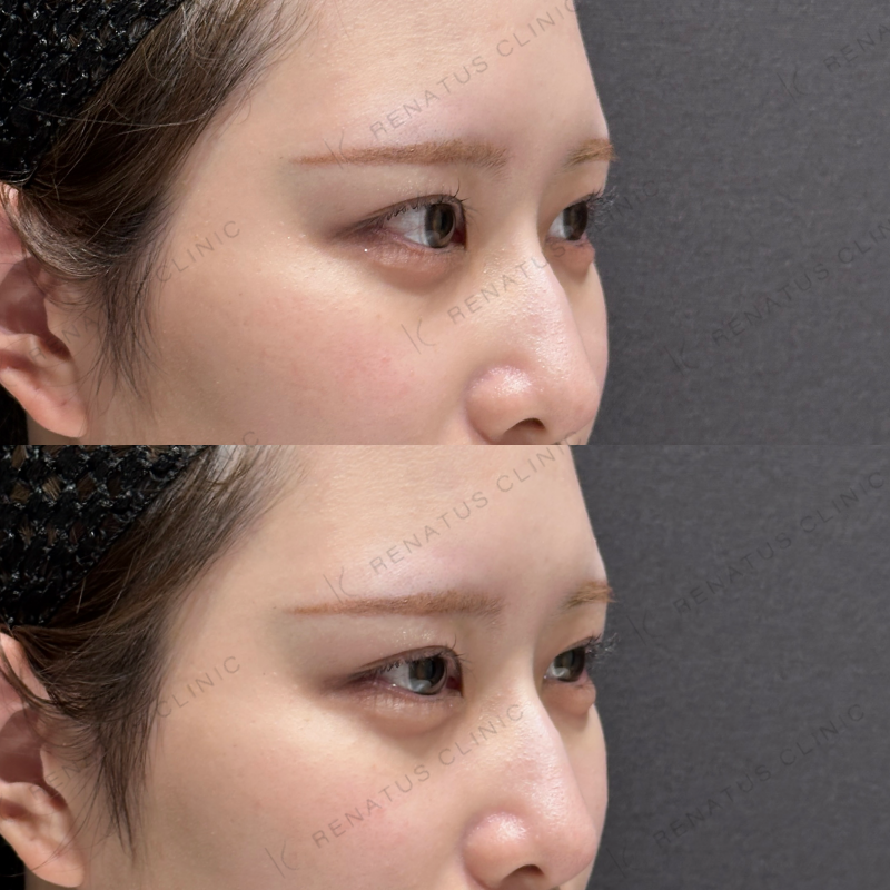 涙袋ヒアルロン酸ボルベラ症例写真 涙袋ヒアルロン酸ボルベラ症例写真