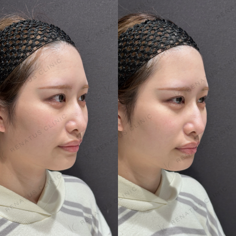 涙袋ヒアルロン酸ボルベラ症例写真 涙袋ヒアルロン酸ボルベラ症例写真