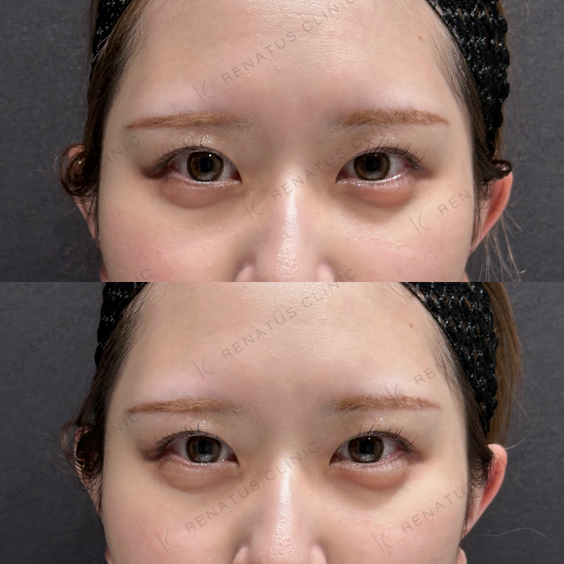 涙袋ヒアルロン酸ボルベラ症例写真 涙袋ヒアルロン酸ボルベラ症例写真