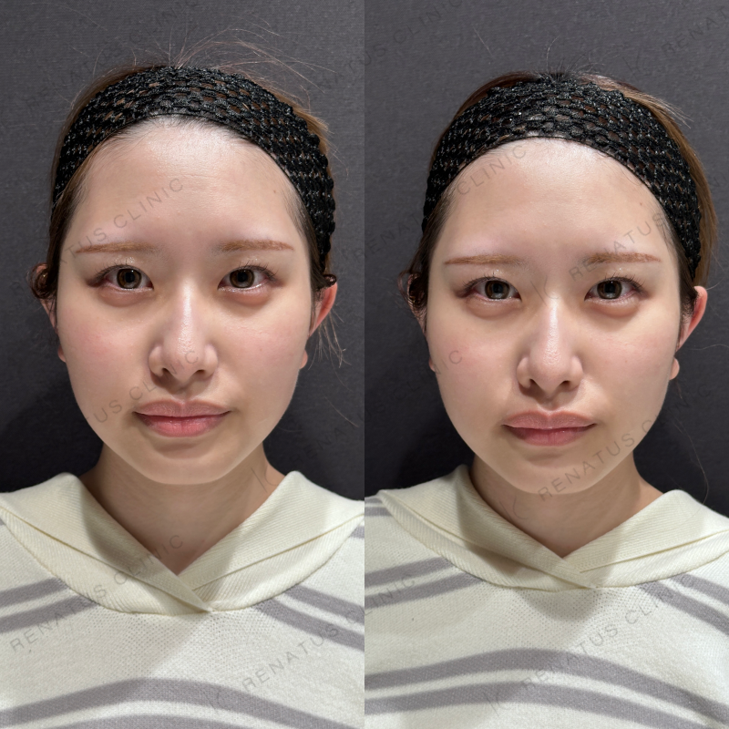 涙袋ヒアルロン酸ボルベラ症例写真 涙袋ヒアルロン酸ボルベラ症例写真