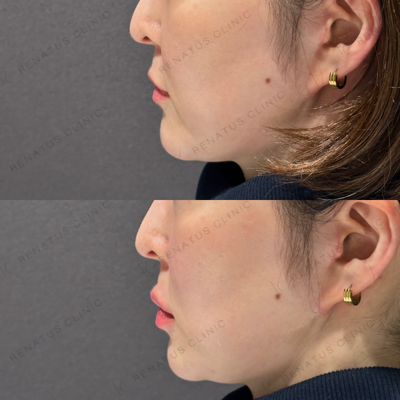 唇ヒアルロン酸ボルベラ症例写真610 唇ヒアルロン酸ボルベラ症例写真