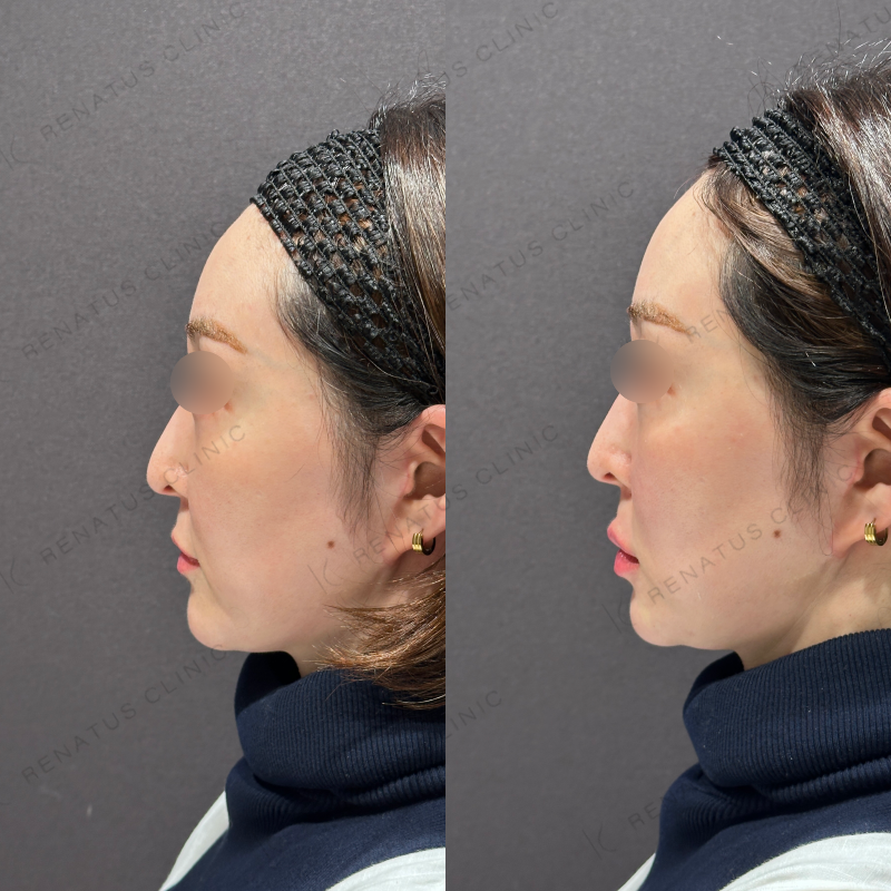 唇ヒアルロン酸ボルベラ症例写真 唇ヒアルロン酸ボルベラ症例写真