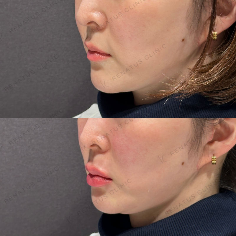 唇ヒアルロン酸ボルベラ症例写真 唇ヒアルロン酸ボルベラ症例写真