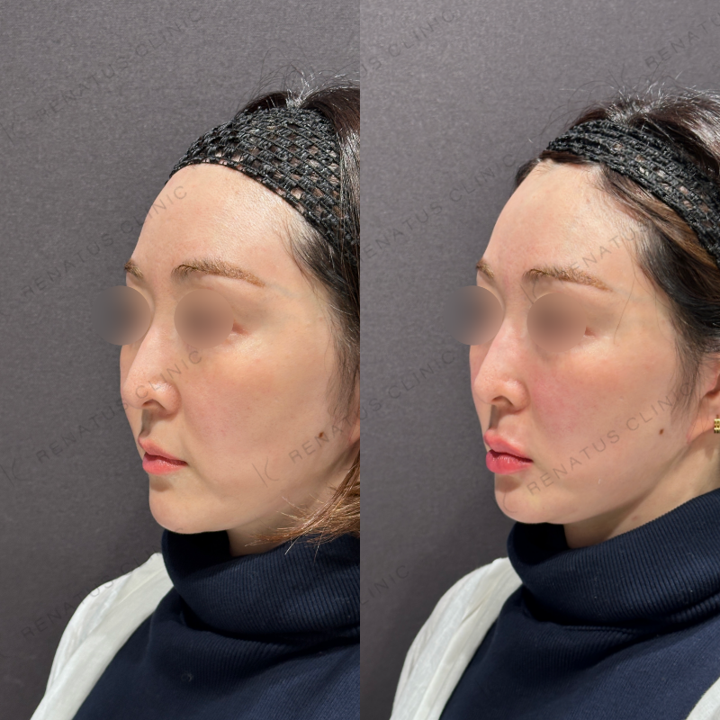 唇ヒアルロン酸ボルベラ症例写真 唇ヒアルロン酸ボルベラ症例写真