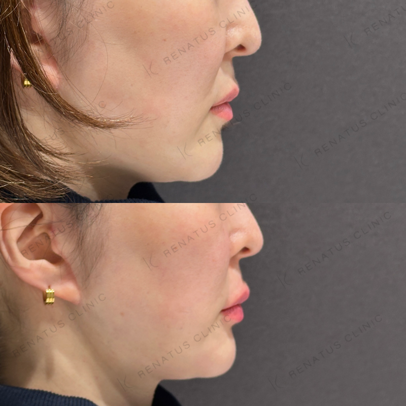 唇ヒアルロン酸ボルベラ症例写真 唇ヒアルロン酸ボルベラ症例写真