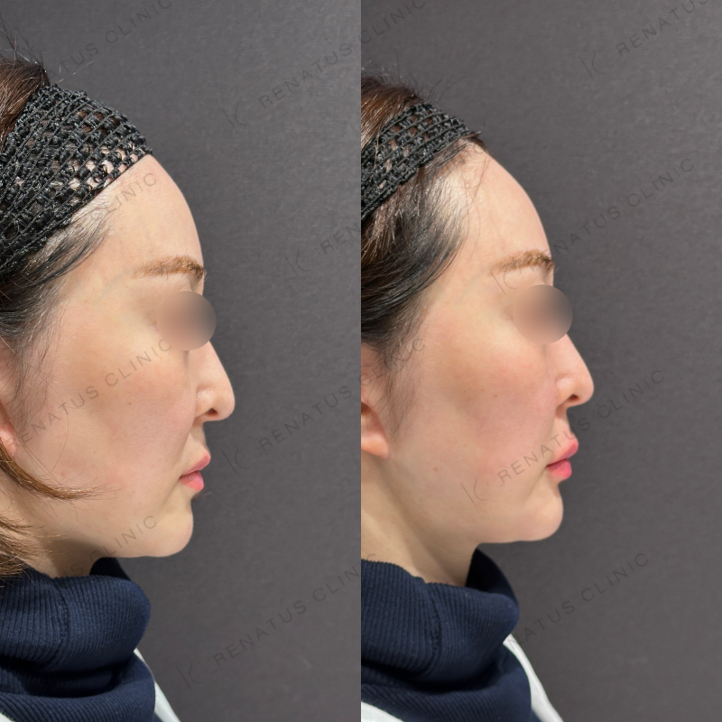 唇ヒアルロン酸ボルベラ症例写真 唇ヒアルロン酸ボルベラ症例写真