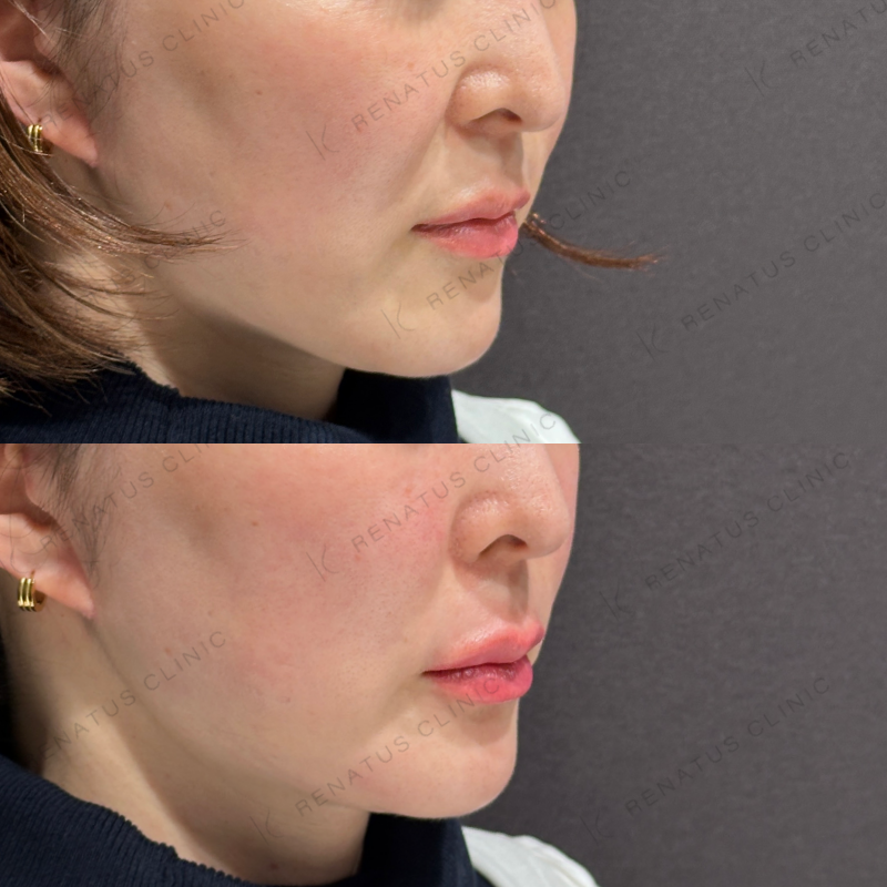 唇ヒアルロン酸ボルベラ症例写真 唇ヒアルロン酸ボルベラ症例写真