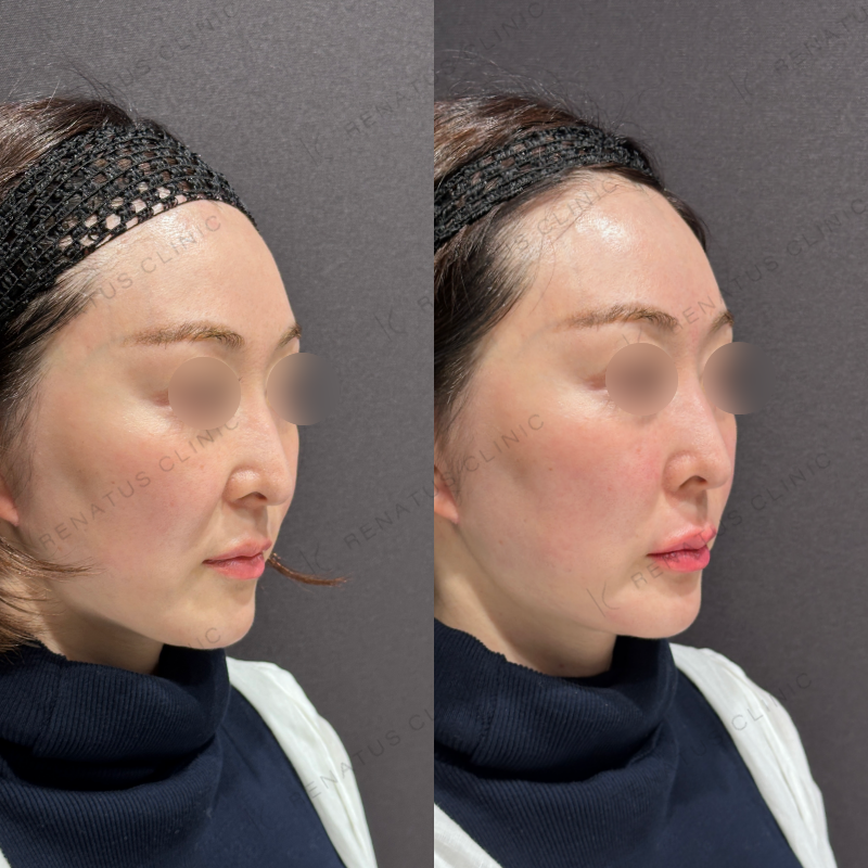 唇ヒアルロン酸ボルベラ症例写真 唇ヒアルロン酸ボルベラ症例写真