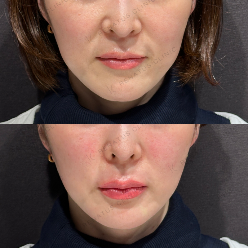 唇ヒアルロン酸ボルベラ症例写真 唇ヒアルロン酸ボルベラ症例写真